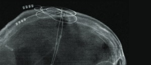 A skull x-ray shows deep brain stimulation electrodes inside the brain of a minimally conscious patient, along with wires as they come out of the skull, prior to a pacemaker being placed in the chest wall and attached, in a 2007 study in Nature.